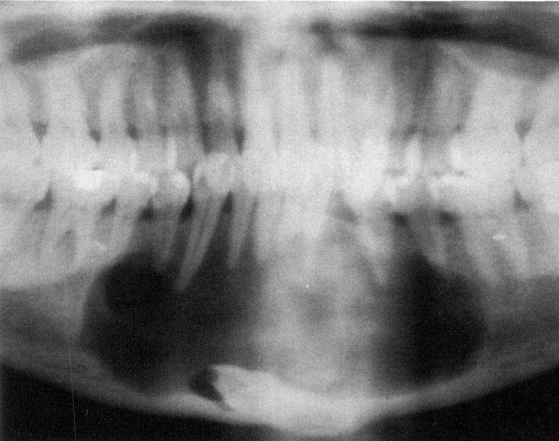 第五节 牙源性角化囊肿